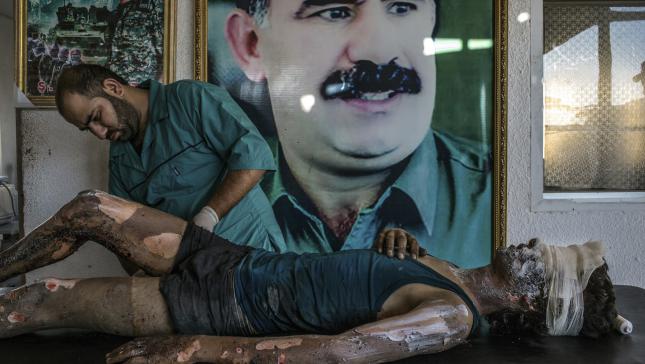 Primer premio individual en la categoría de noticias generalMauricio Lima, Brazil.  Un médico frota pomada en las quemaduras de un joven de 16 años de edad, herido por el Estado Islámico, llamado Jacob delante de un cartel de Abdullah Ocalan, el líder encarcelado del Partido de los Trabajadores del Kurdistán, en un recinto del hospital a las afueras de Hasakah, Siria el 01 agosto de 2015.